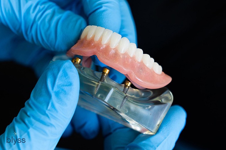 featured-image-snap-in-dentures-blyss-dental